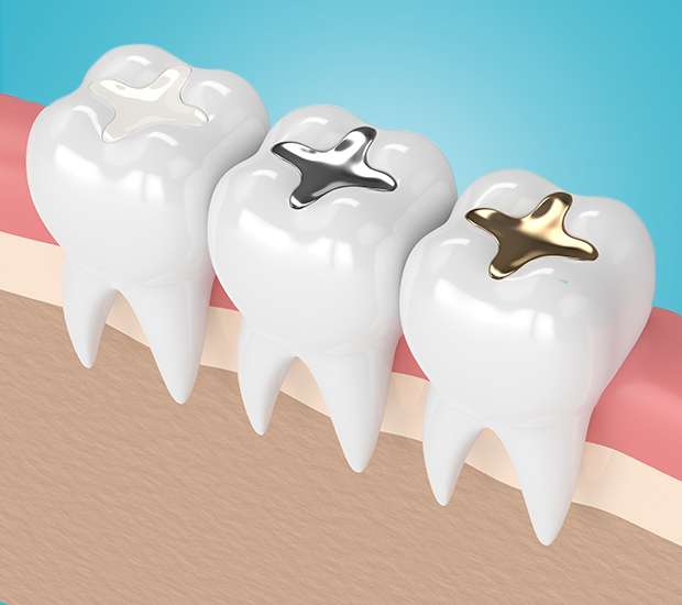 Encinitas Composite Fillings