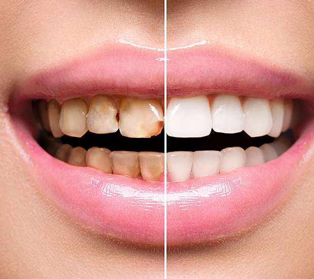 Encinitas Dental Implant Restoration