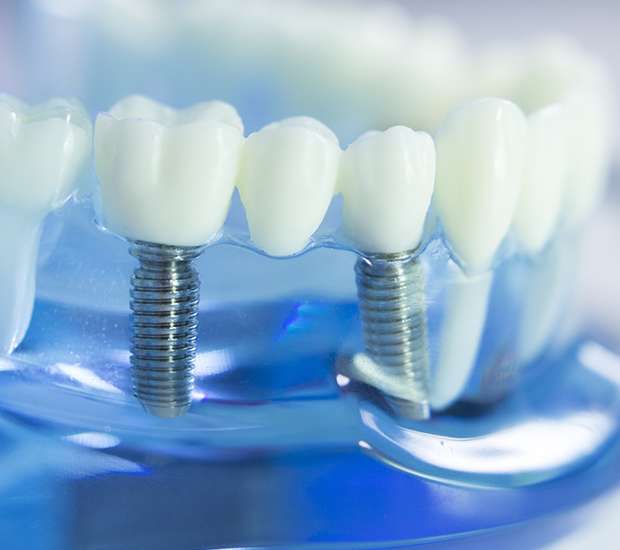 Encinitas Dental Implants