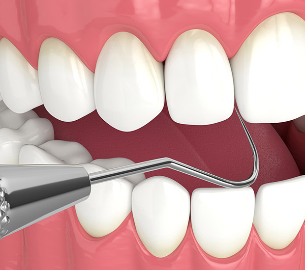 Encinitas Interactive Periodontal Probing